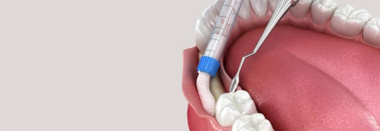 Graphic illustration of interior mouth of bone grafting.