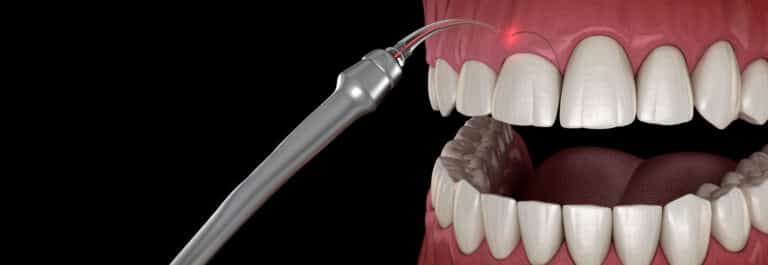 Graphic illustration of teeth with laser pointed along gum line.