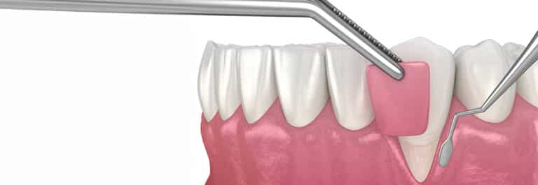 Graphic illustration of grafting gum lines next to tooth.