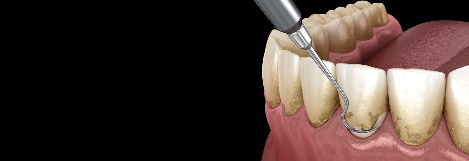 Graphic illustration of dental tool scraping.