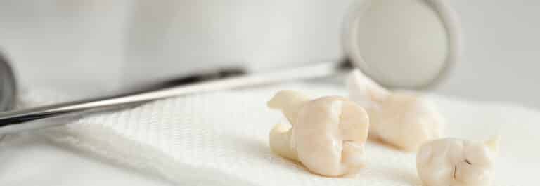 Cleaned, adult teeth lying on dental tray post-extraction.