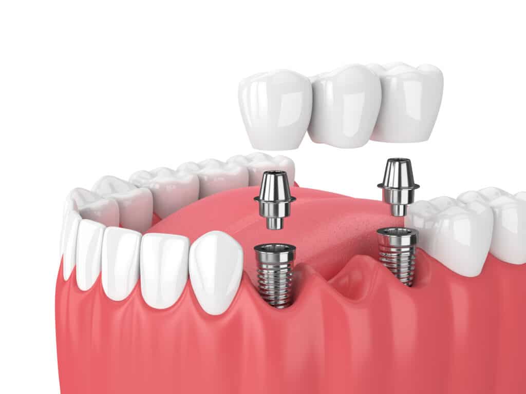 3D rendering of the jaw and dental implants of a bridge.