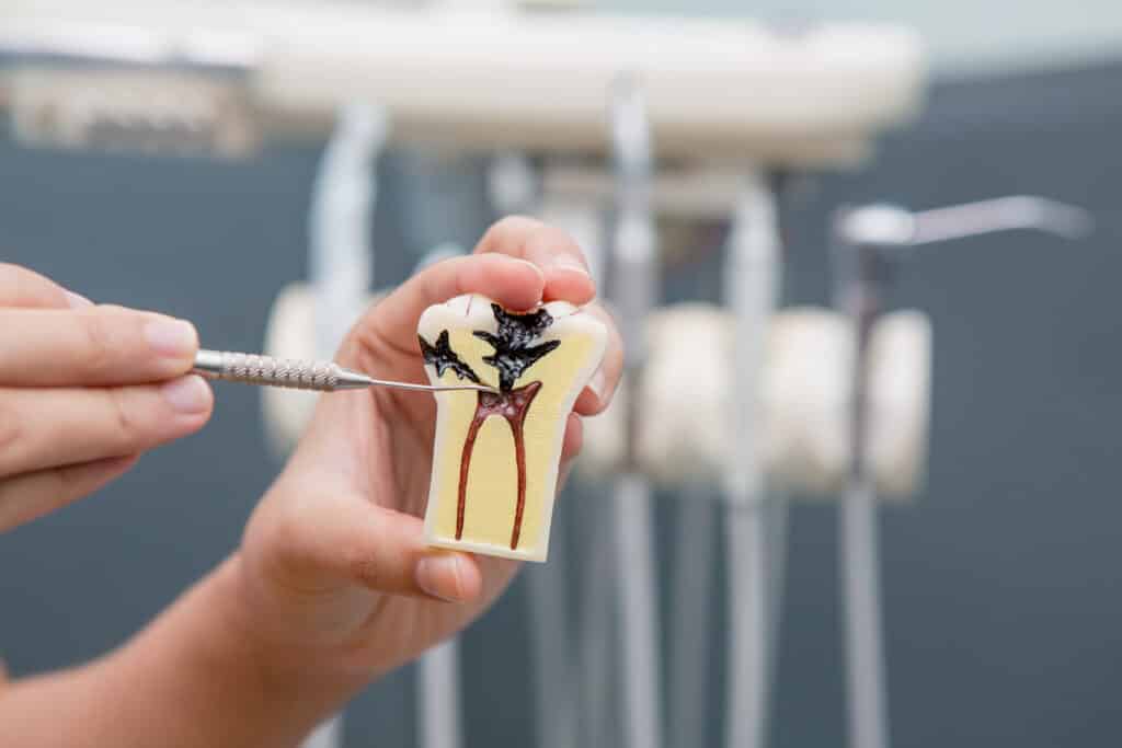 Dental tooth model of root canal.