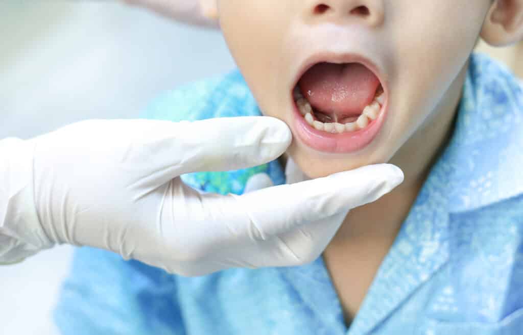 Child with mouth open showing tongue-tie to doctor.