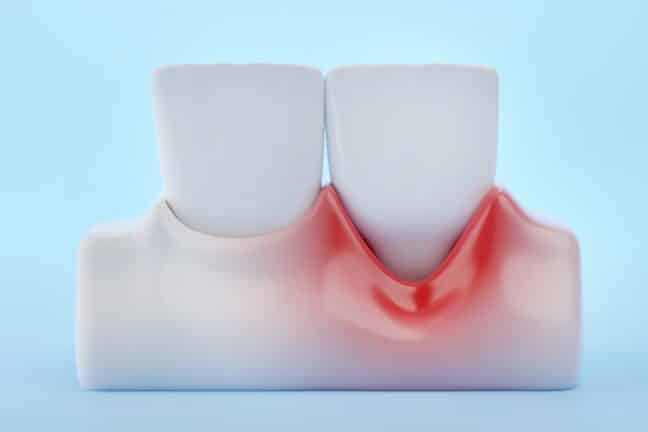 Gum recession on 3D rendering of teeth.