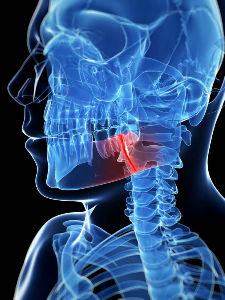 Medical illustration of a broken jaw bone.