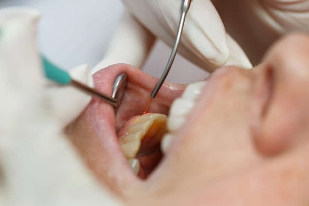 Close up of dental laser being using on a patient's gum tissue.