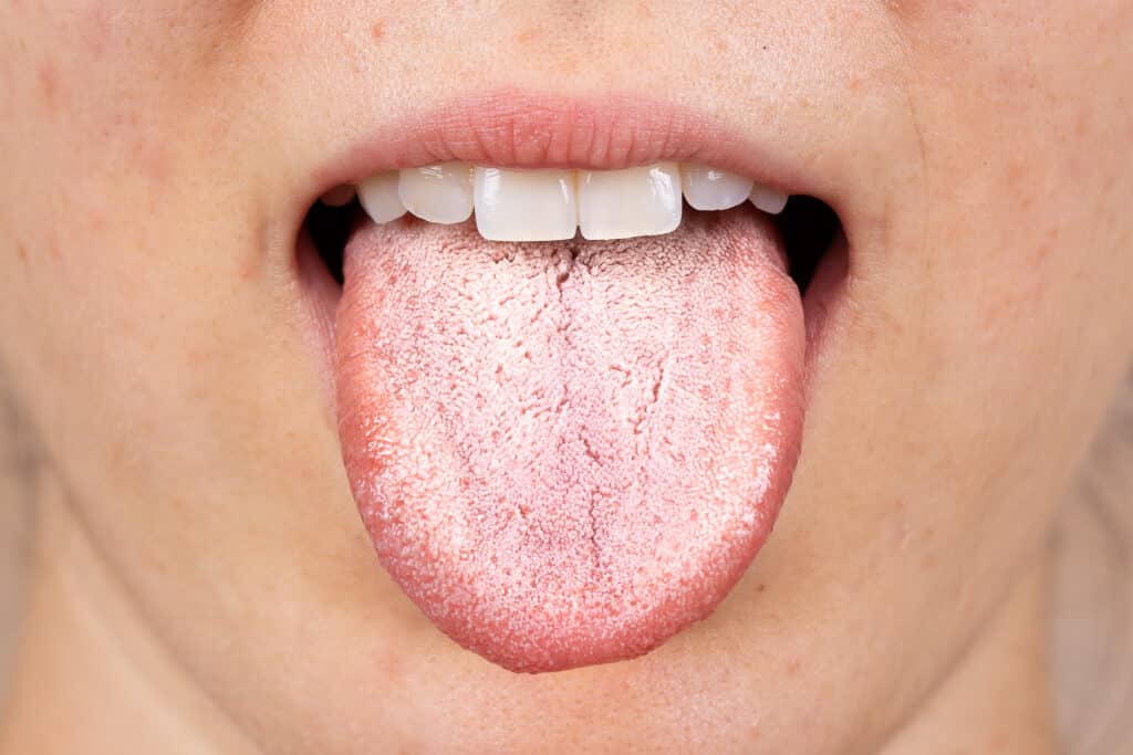 Close up of person sticking out tongue with white patches.