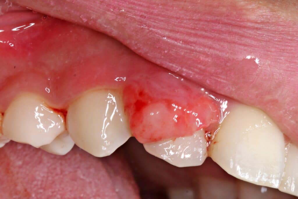 Close up of patient's gums and teeth with symptoms of growth.