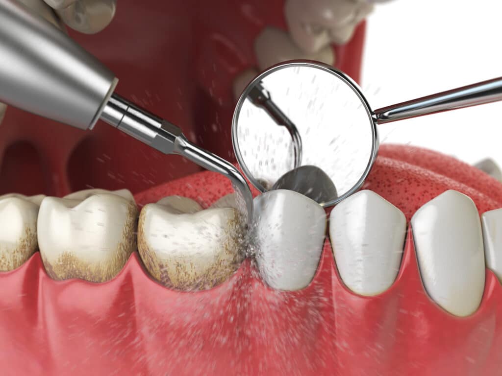 Graphic illustration of ultrasonic teeth cleaning.