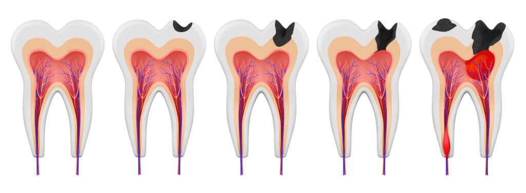 Stages of caries development in a human molar in a 3d graphic illustration.