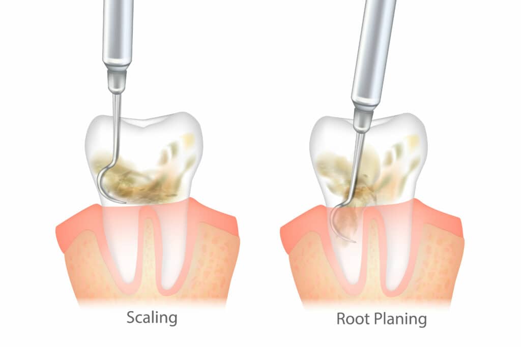 Illustration of the difference of Periodontal Scaling and Root Planing showing the cleaning treatment.