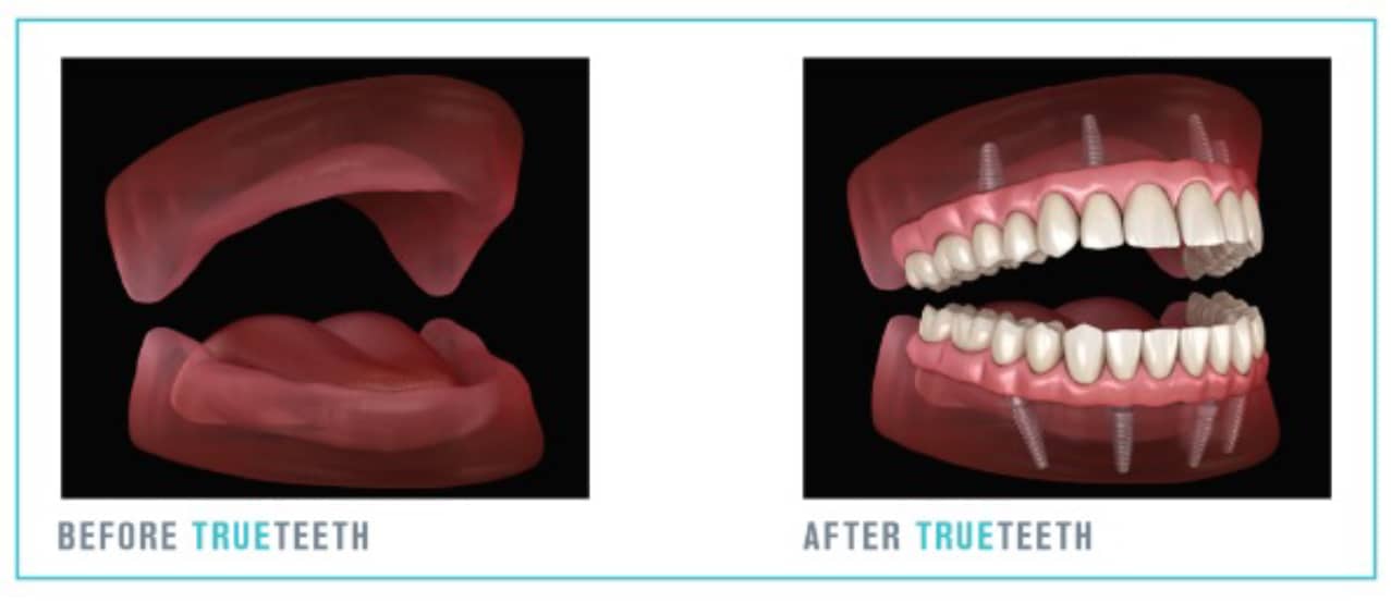 Visual of teeth before and after TrueTeeth