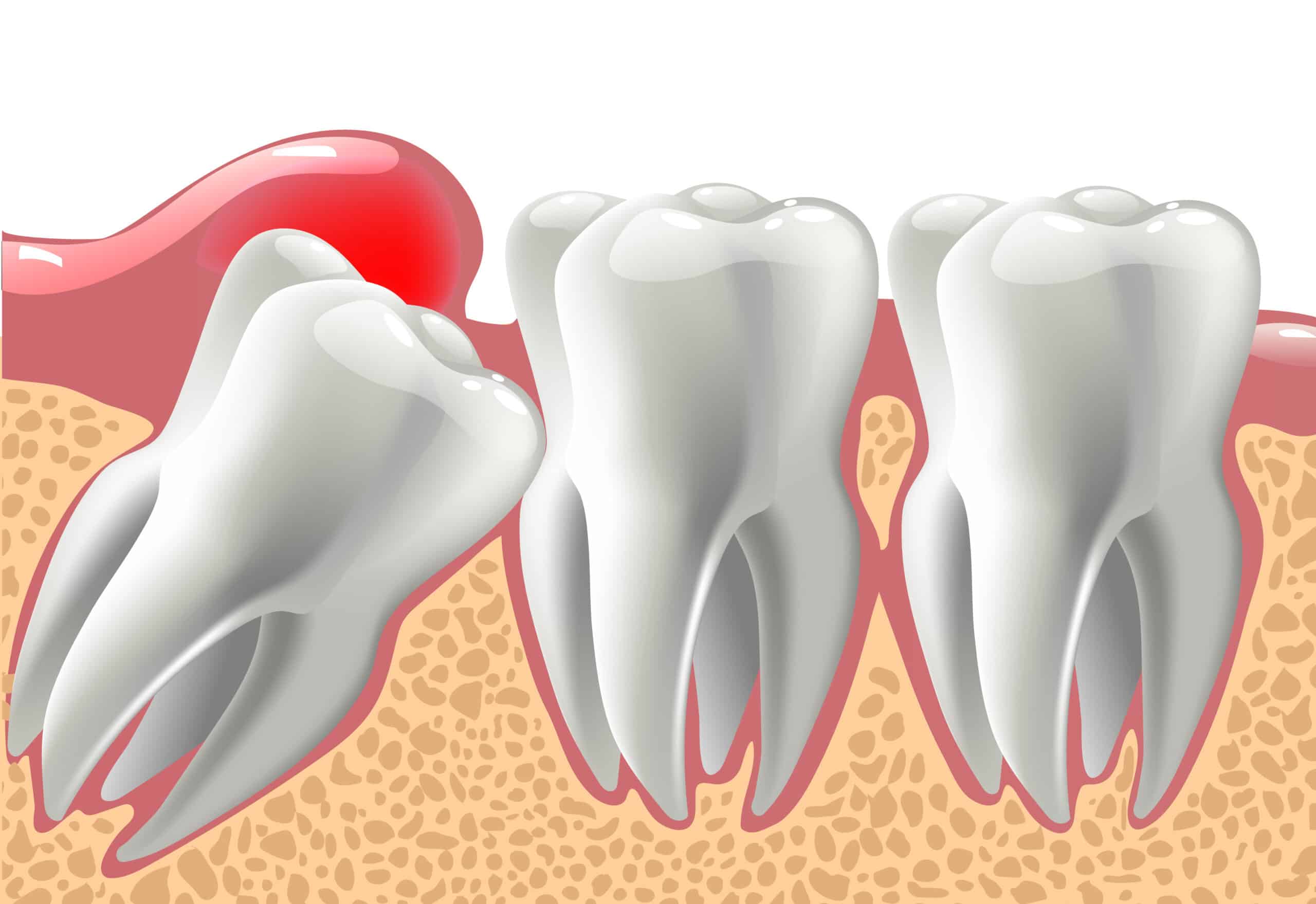 Graphic illustration of 3D teeth with wisdom tooth.